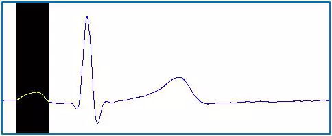 Az emberi EKG