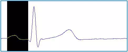 Az emberi EKG