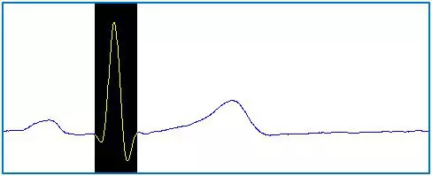 Az emberi EKG