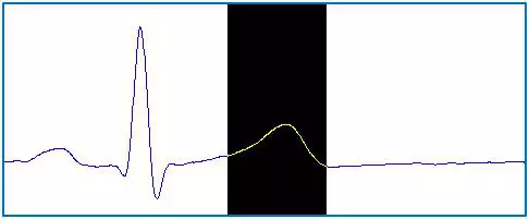 Az emberi EKG