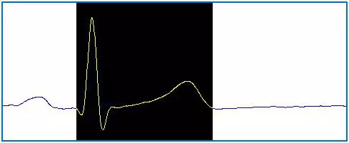 Az emberi EKG