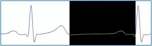 Az emberi EKG